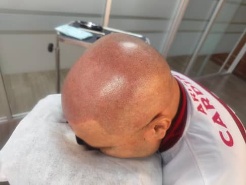 Slider image (9) SMP Advanced - Scalp Micro Pigmentation